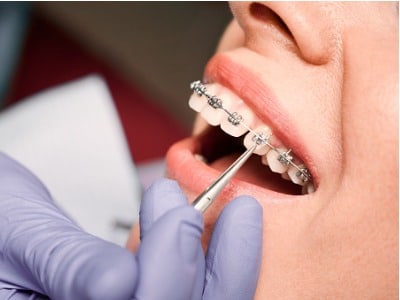 The Importance of Phase 1 Orthodontic Treatment: EZ Dental: Family Dentists