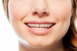 Orthodontic Treatment Timeline in Gainesville and Oakwood, GA Sosebee & Britt Orthodontics