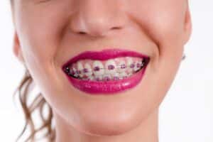 Can You Whiten Teeth While Wearing Braces in Oakwood, GA? Sosebee & Britt Orthodontics in Gainesville, GA